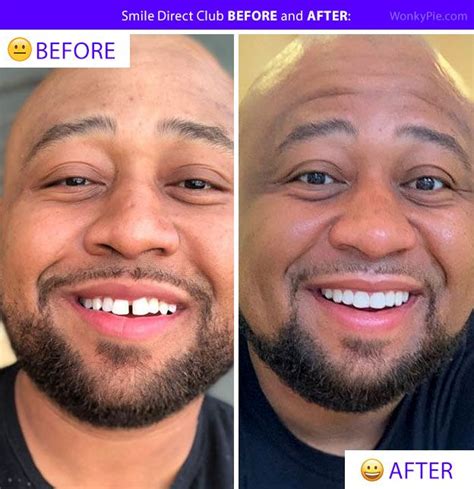smiledirectclub results